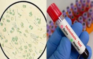 मध्यप्रदेश में मेलियोइडोसिस का अलर्ट, 4 राज्यों तक पहुंचा संक्रमण; मिट्टी-पानी से फैलता है जानलेवा रोग