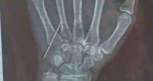 गोरखपुर में डॉक्टर की लापरवाही: 15 साल की बच्ची की नस में तोड़ा नीडल, CMO ने जांच के आदेश दिए