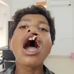 ‘चिरायु’ दल ने लौटाई मुस्कान, जन्मजात कटे होंठ और तालु से मिली मुक्ति