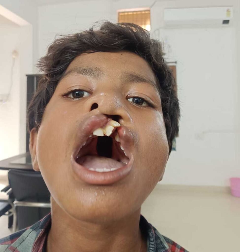 ‘चिरायु’ दल ने लौटाई मुस्कान, जन्मजात कटे होंठ और तालु से मिली मुक्ति