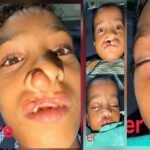 चिरायु योजना से जन्मजात समस्या से मिली राहत, तीन बच्चों के चेहरों पर लौटी मुस्कान