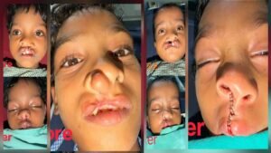 चिरायु योजना से जन्मजात समस्या से मिली राहत, तीन बच्चों के चेहरों पर लौटी मुस्कान